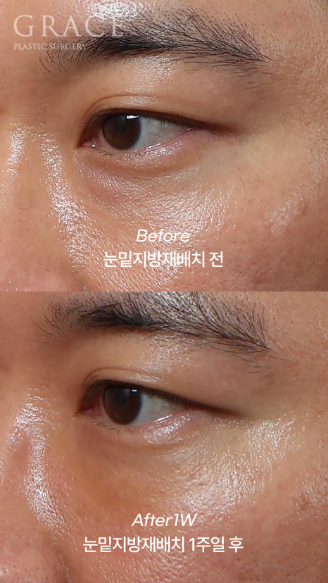 눈두덩이 지방이식 vs 눈밑지방재배치 (40대 중반 남자자&middot;비용&middot;붓기) 관련 이미지 2