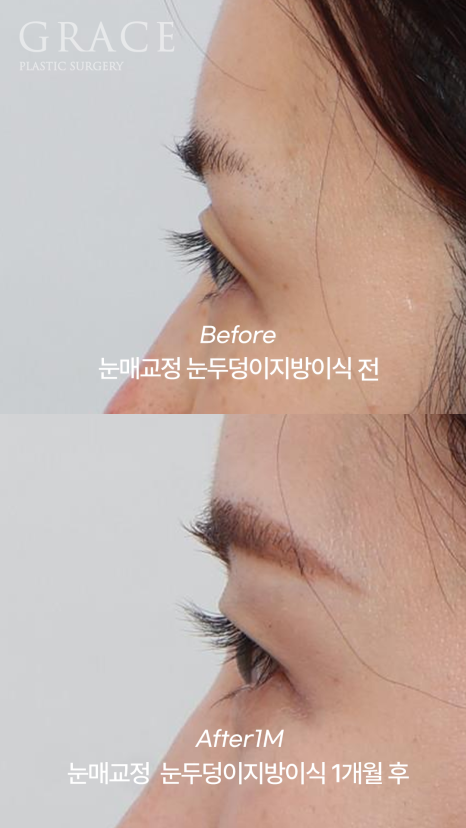 눈두덩이 지방이식 같은 내 지방인데 왜 울퉁불퉁해질까? 지방의 크기부터 다르니깐 관련 이미지 14