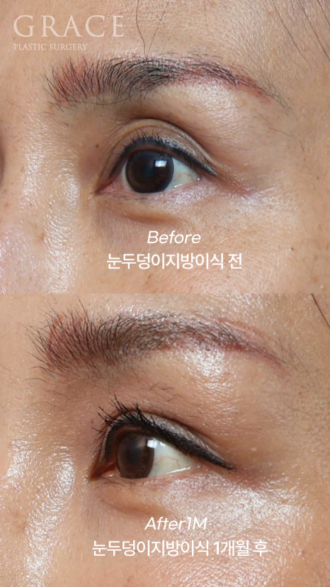 Uneven When You Close Your Eyes? Before-and-After of Eyelid Fat Grafting That Took Well Without Swelling (Compared with Filler) image 6