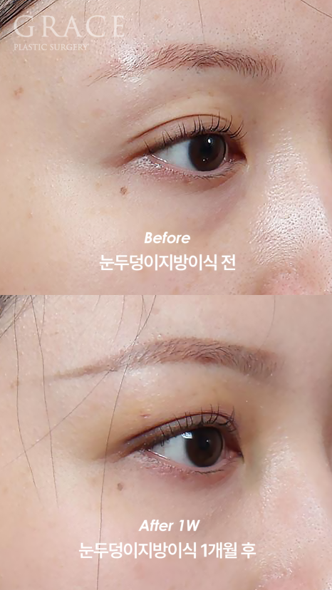 눈을 감았을 때 보이는 멍·흉터·울퉁불퉁함 걱정되나요? 눈두덩이 지방이식 관련 이미지 7