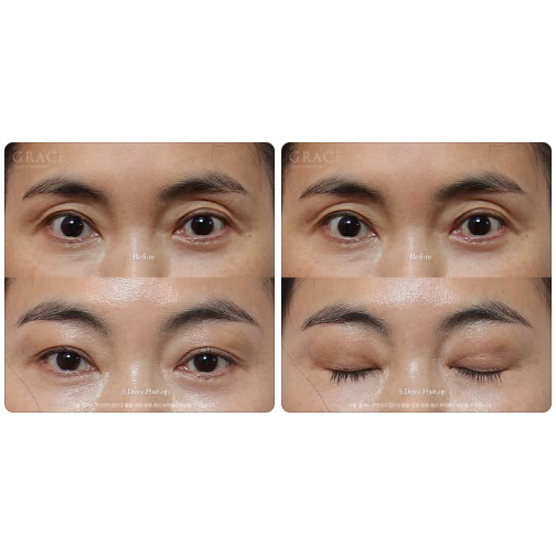 Will a Sunken Upper Eyelid Become Bumpy When You Close Your Eyes After Fat Grafting? image 1