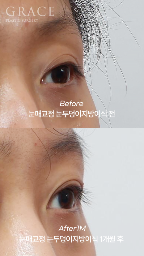 꺼진 눈두덩이 필러 대신 지방이식? 붓기&middot;부작용 없는 방법 정리 관련 이미지 6
