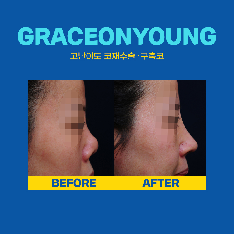 You Can Shorten the Revision Rhinoplasty Period with Stem Cell Nose Surgery! image 2