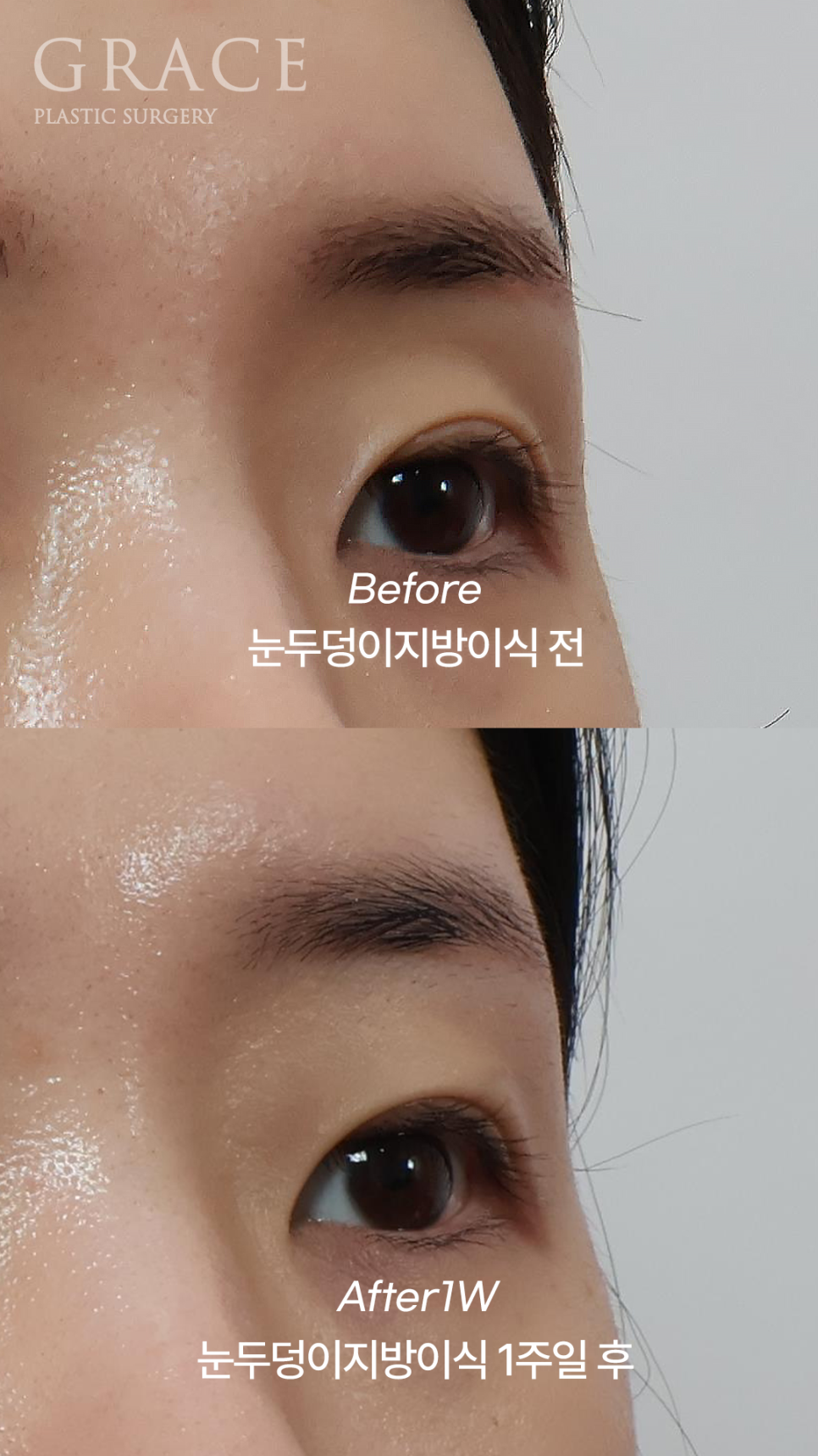 눈두덩이 지방이식 1주일 차 자연스러운 회복 중 관련 이미지 4