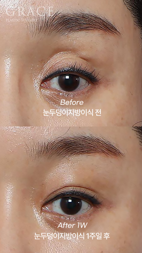 돌출눈성형 전후 움푹 패인 눈꺼풀 지방이식 관련 이미지 10