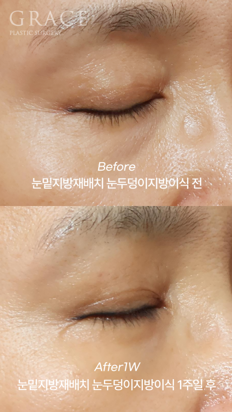 아이홀 꺼짐과 눈밑 지방을 동시에 해결하고 싶다면 관련 이미지 7