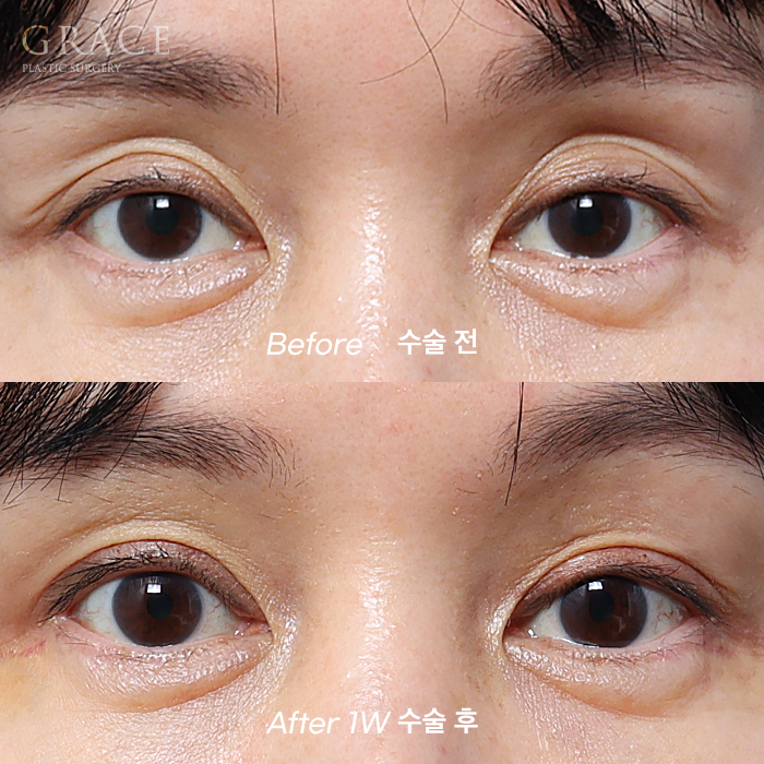 Male Brow Filler? Improvement with Eye-Hole Fat Grafting (Without Worrying About Side Effects, Scars, or Swelling) image 8