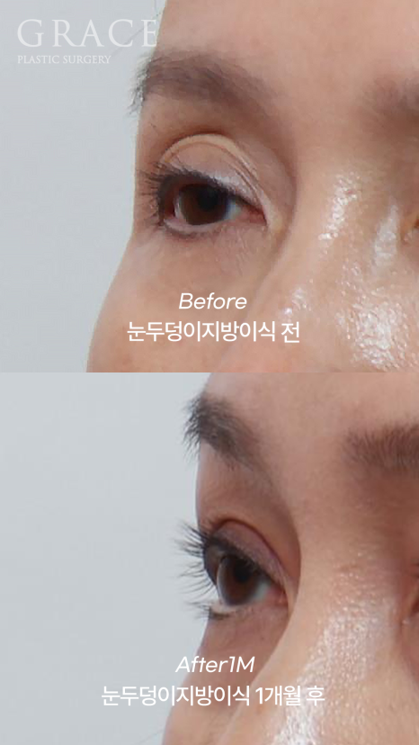 (2차 냉동지방 NO) 생지방으로 자연스럽게 채운 눈두덩이  붓기/부작용 걱정 없이 관련 이미지 8