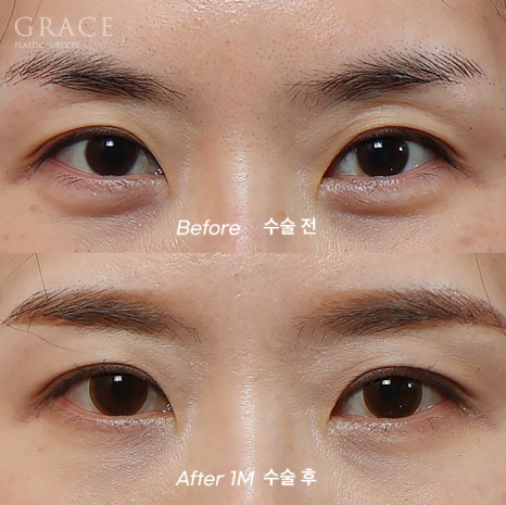 Eye Fat Grafting Instead of Eyelid Filler: Eye Shape Correction (1-Week Swelling Level) image 8