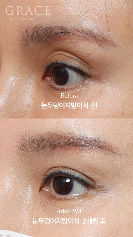 Will Swelling After Eyelid Fat Grafting Last a Long Time... Is It Really True? image 3