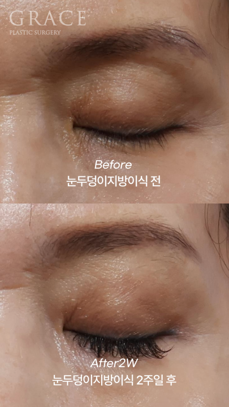 Concerns About Swelling and Side Effects After “Eye Hollow Fat Grafting” Surgery in the Eye Socket Area for People in Their 60s image 5