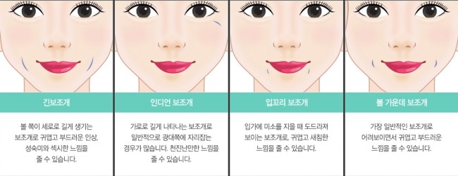 밋밋한 얼굴에 뽀~인트! 그레이스성형외과 보조개 수술 관련 이미지 4