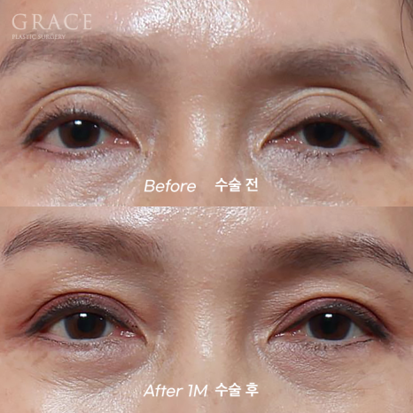 In Your 50s, Restoring a Youthful Look with Before-and-After Eye Surgery and Fat Grafting to the Upper Eyelids, Temples, Under-Eyes, and Above the Brows image 8