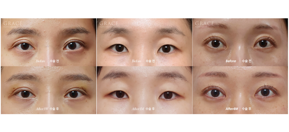 If You’re Curious About Eyelid Fat Grafting Reviews, Costs, Prices, and Side Effects image 2
