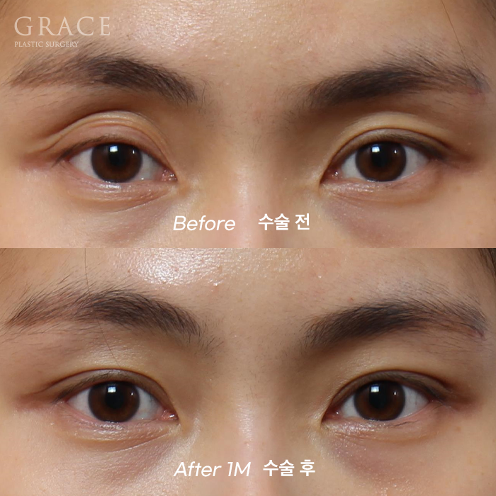 …The Result of Eyelid Fat Grafting (If You’re Worried About Side Effects and Swelling) image 10