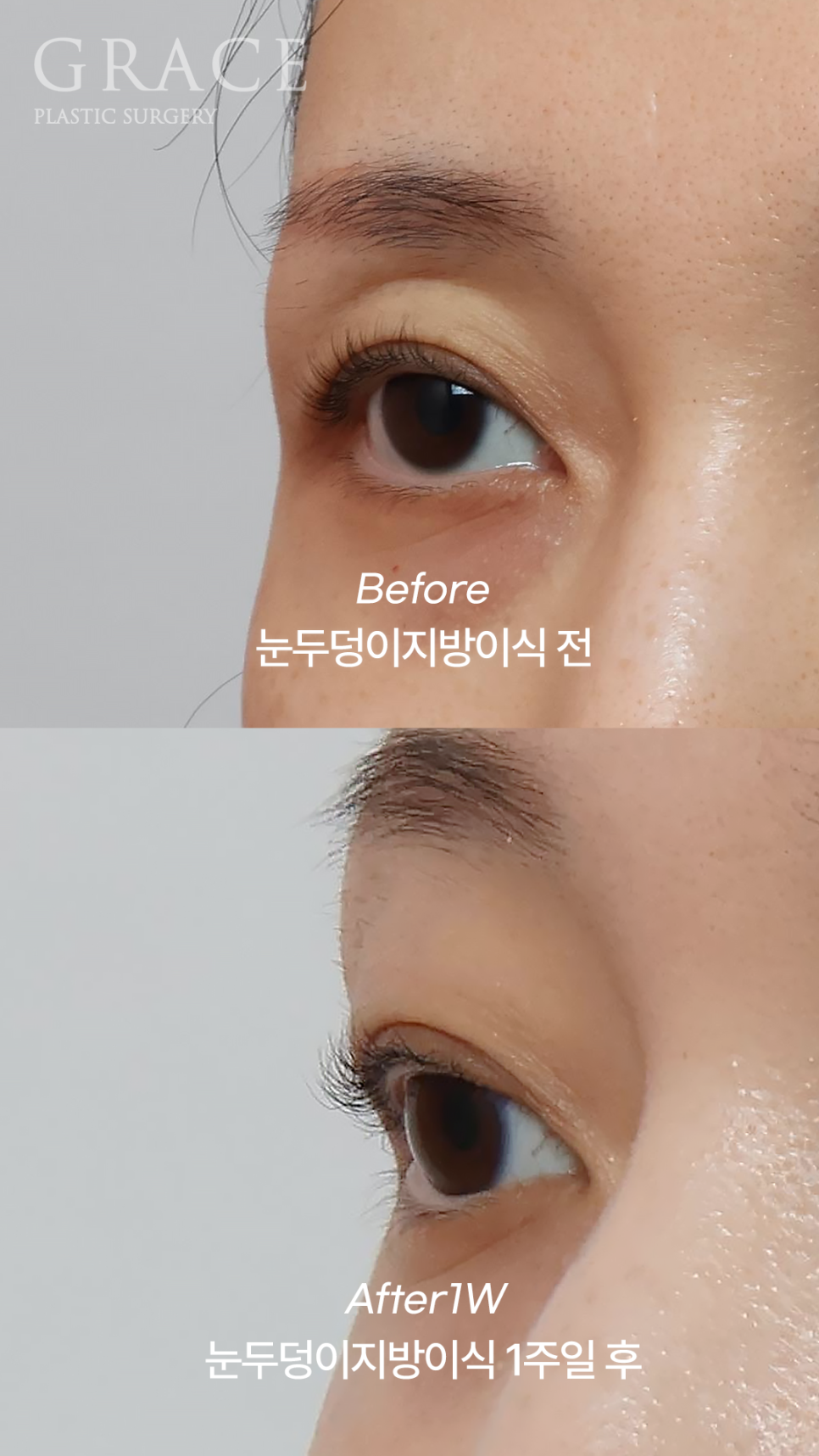 Sunken Eyelid Fat Grafting: Swelling After 1 Week Before & After image 6