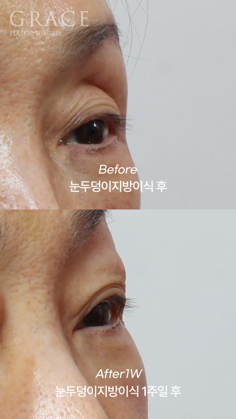 Upper Eye Hollowing and Sunken Brow Bone: Before and After 1 Week of Fat Grafting for a Patient in Her Mid-70s image 7
