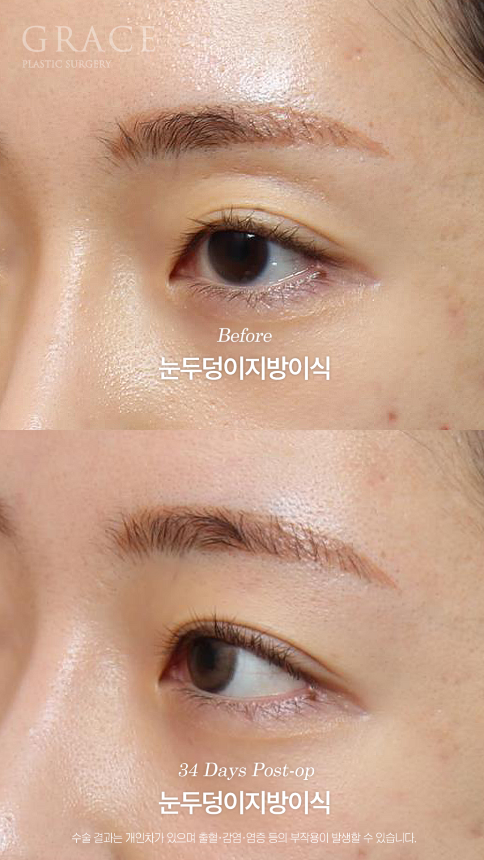 눈두덩이 지방이식이 필요한 경우 진료실에서는 무엇을 볼까요? 관련 이미지 6