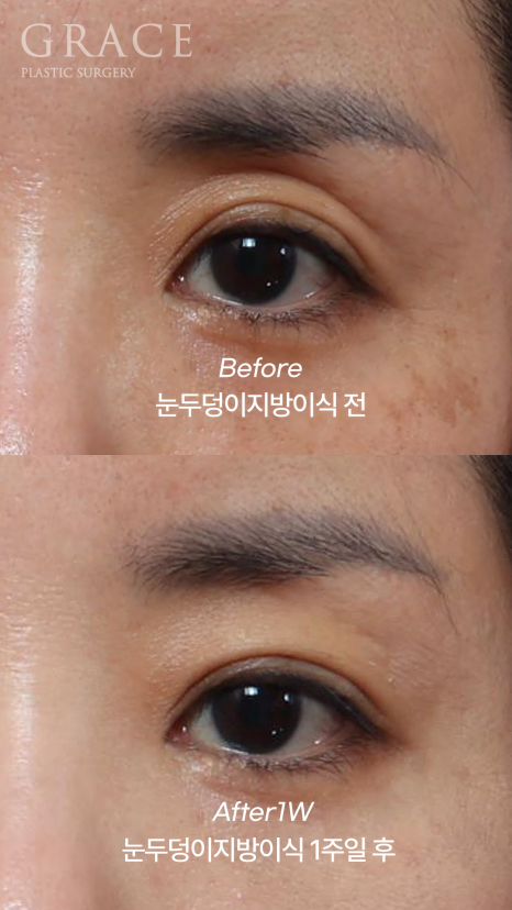 Week 1 After Upper Eyelid Fat Grafting in the Mid-40s: A Natural Return Without Swelling image 5