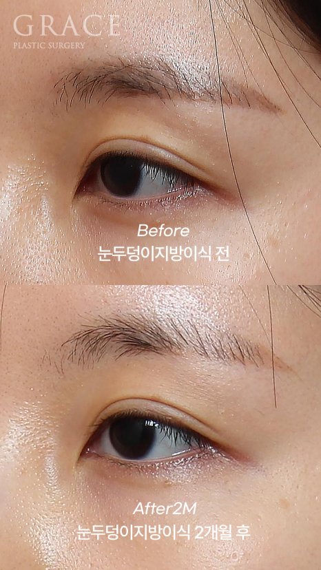 Upper Eyelid Fat Grafting That Shows When You Close Your Eyes? The Cause of Side Effects Is Different image 3