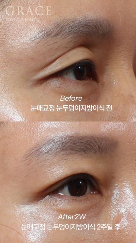 2-Week Swelling Progress After Upper Eyelid Fat Grafting + Incisional Ptosis Correction in Your 40s image 5