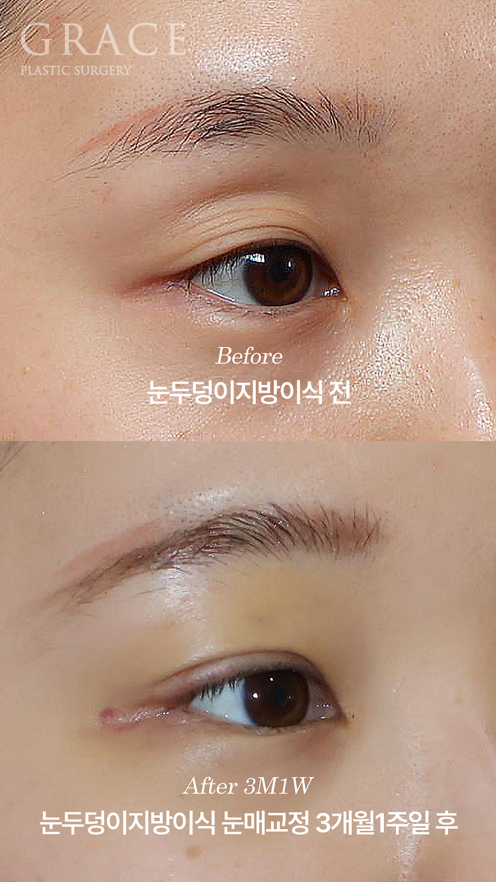 Why Choose Upper Eyelid Fat Grafting Instead of Eye-Hollow Filler? image 6