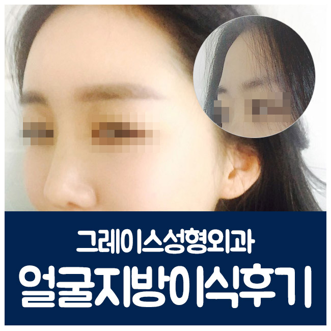 얼굴지방이식후기, 탄력있고 윤기있는 동안얼굴 관련 이미지 5