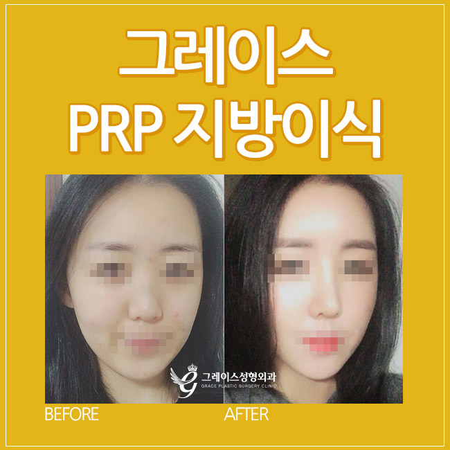 얼굴지방이식후기, 그레이스성형외과 SPRP지방이식 관련 이미지 1