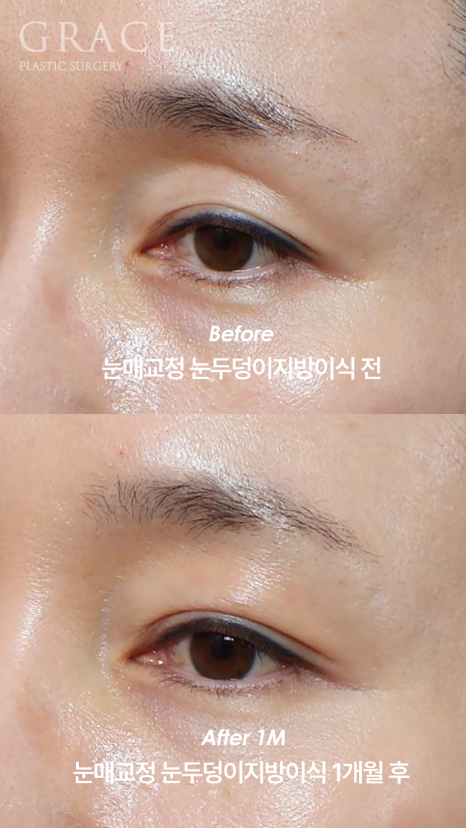 What Is the Problem with the Side Effects of a Lumpy Eyelid Fat Graft? image 8