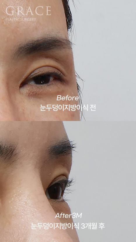 Grace Plastic Surgery 40s Case: Improved Eye-Opening Strength After Upper Eyelid Fat Grafting image 6