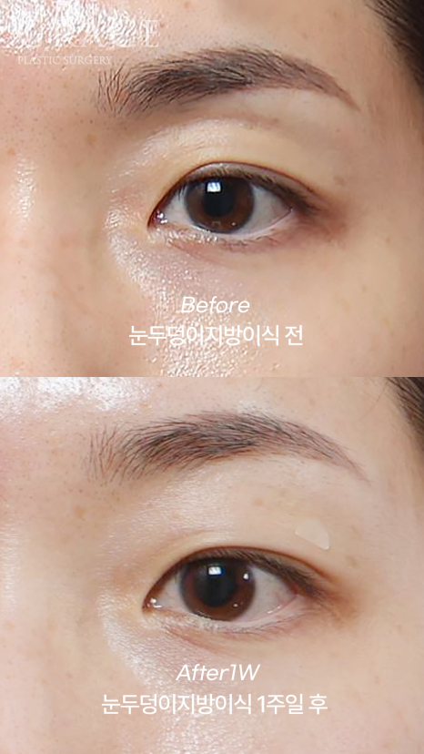 Eyebrow Fat Grafting &middot; Eyelid Fat Grafting &middot; Sunken Eyes Surgery Cost Information (As of June 2025) image 7