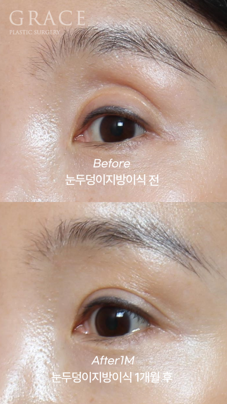 눈 위 지방이식 감으면 울퉁불퉁? 왜? 관련 이미지 1