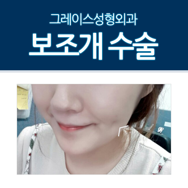 내 얼굴의 자연스러운 포인트! 그레이스 보조개수술 관련 이미지 1