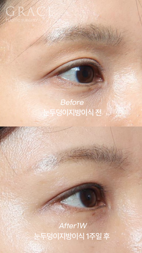 눈두덩이 지방이식 가격보다는 주입방식 관련 이미지 2