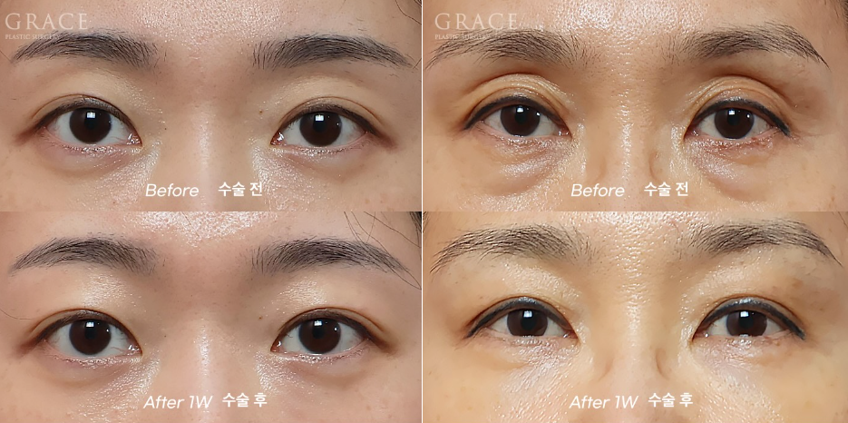 Why Do Hollow Eyelids Occur, and How Can They Be Naturally Improved? (Research Notes from a Doctor Performing Eyelid Fat Grafting) image 11