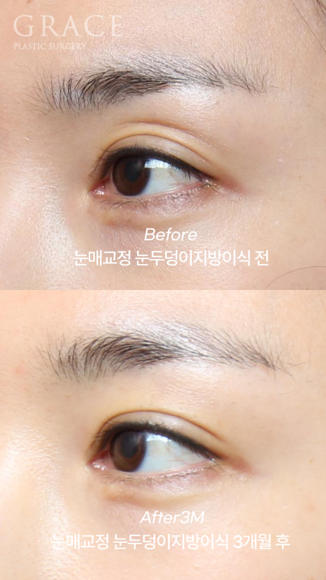 눈꺼풀지방이식+눈매교정 1주일 차 붓기&middot;노란 멍 그 후 3개월 관련 이미지 7