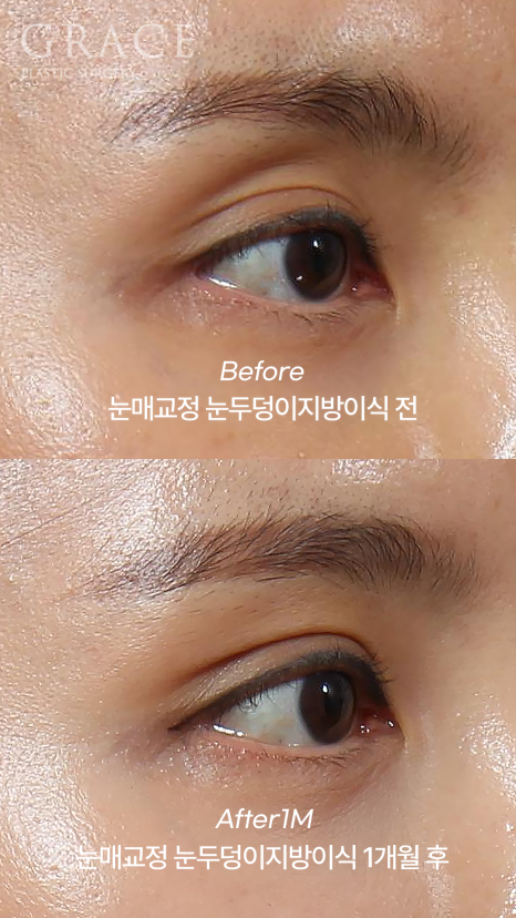 Side Effects of Eyelid Fat Grafting? One-Month Engraftment Period When Eyelid Correction Is Performed image 2