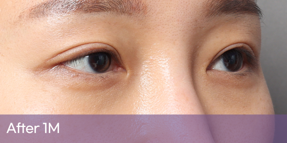 Fatigue-Looking Eyes? Eyelid Fat Grafting image 3