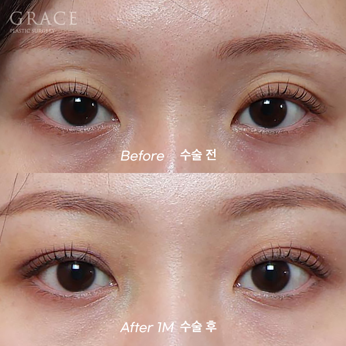 Upper Eyelid Fat Grafting Before and After in a Person in Their Late 50s and a Person in Their Late 20s image 2