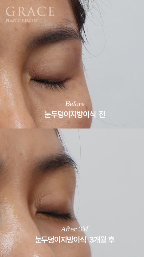 안와지방 주입 &middot; 눈두덩이지방이식 (1cc / 0.9cc) 관련 이미지 8