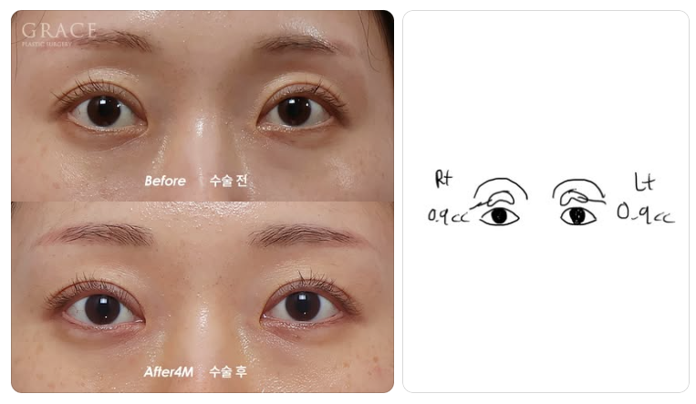 The Real Cause of Side Effects from Upper Eyelid Fat Grafting: the Injection Layer (Orbicularis Oculi Muscle & Orbital Fat) image 7