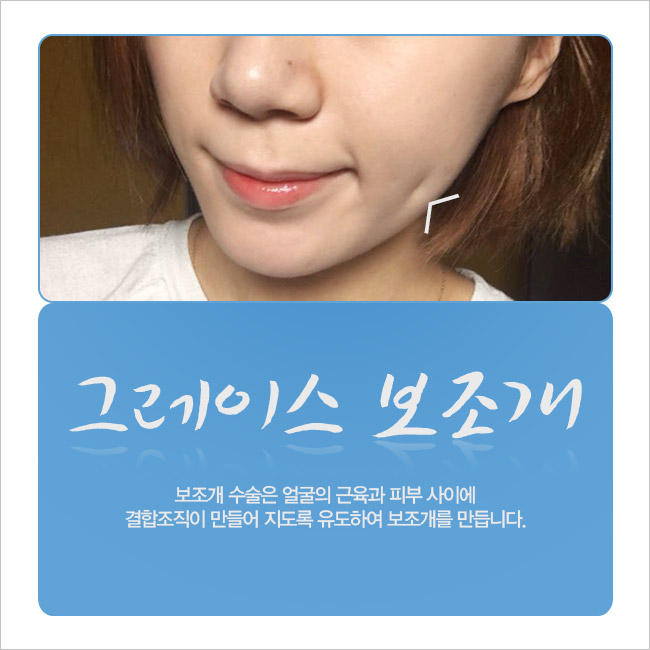 보조개수술은 어디?! 신사역 그래! 그레이스성형외과 관련 이미지 5