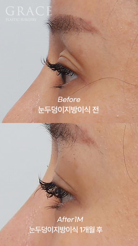 Why Injecting Fat Into the “Orbital Fat” Is Important in Sunken Eye Fat Grafting (dr.essay) image 5