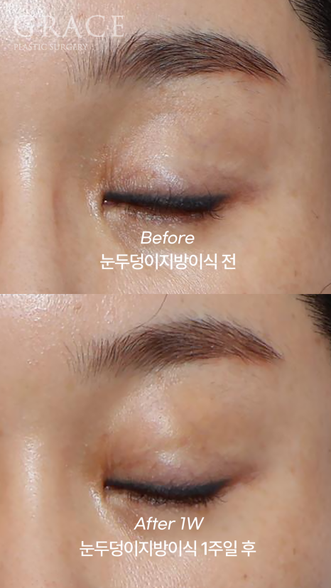 돌출눈성형 전후 움푹 패인 눈꺼풀 지방이식 관련 이미지 9