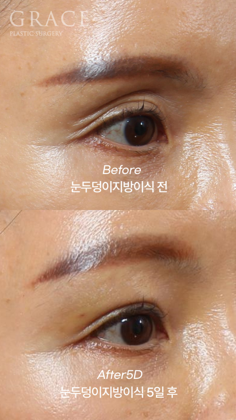 How Long Can Sunken Upper Eyelids Last Without Side Effects After Fat Grafting? image 8