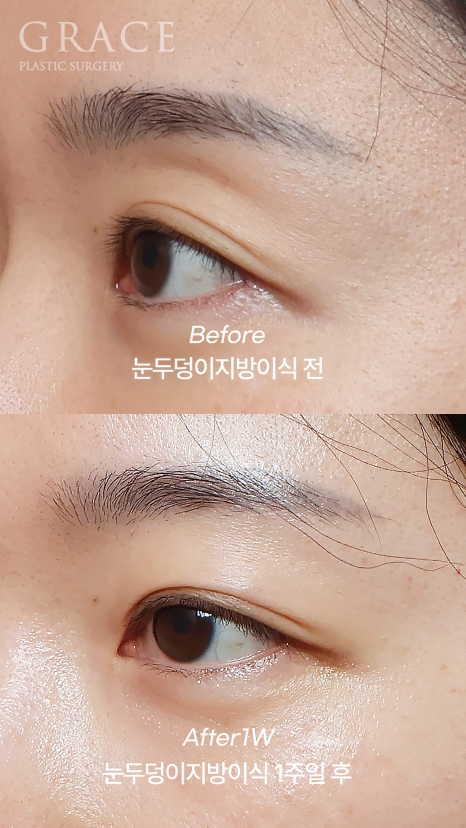 No to Frozen Fat That’s Completely Frozen! Eyelid Fat Grafting with Only Fresh Autologous Fat image 6