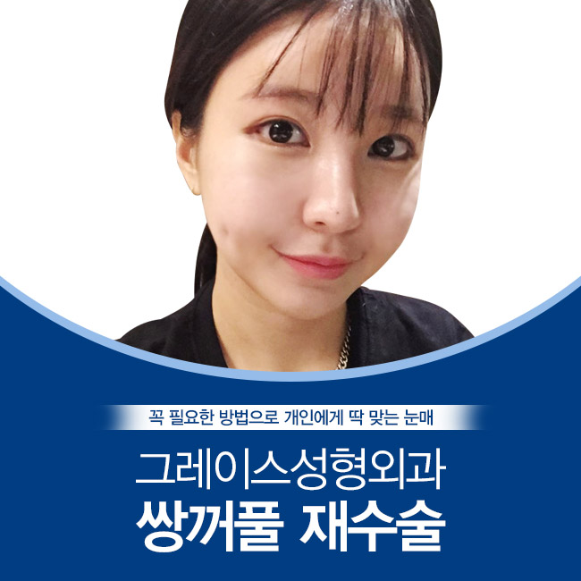 성공적인 쌍꺼풀재수술, 그레이스성형외과 관련 이미지 4