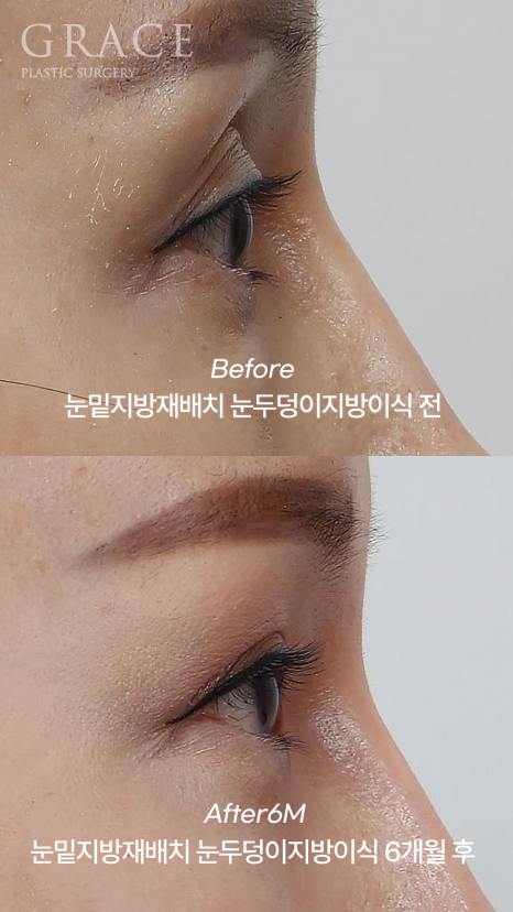 Eye Surgery for People in Their 50s That Reduces Time, Cost, and Recovery: Upper Eyelid Fat Grafting & Under-Eye Fat Repositioning image 6