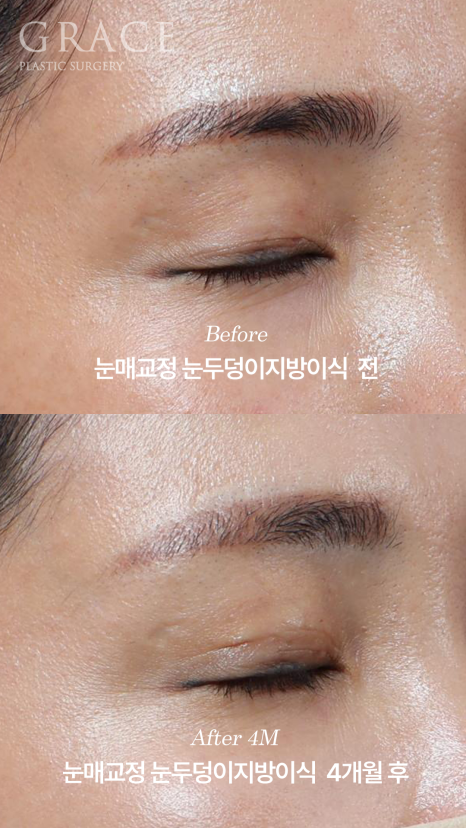 눈두덩이지방이식 11개월 후 부작용 없이 유지되는 변화 관련 이미지 8