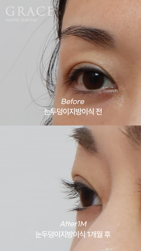 How Long Does Upper Eyelid Fat Grafting Last? The Facts About Maintenance Period image 8